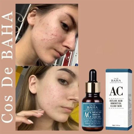 سرم ضد جوش همه کاره آزلائیک اسید کاز دی باها Cos De BAHA Azelaic Acid Hinokitiol Clear Skin Serum 30ml