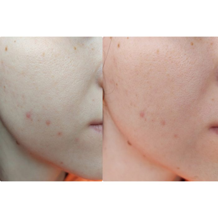 سرم ضد لک و جوش اکسیس وای AXIS-Y Spot The Difference Blemish Treatment