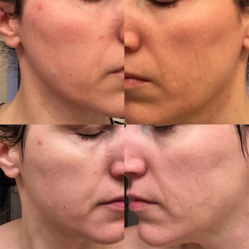 ژل ضد جوش و لایه بردار دیفرین Differin Adapalene Gel 0.1% Retinoid Acne Treatment