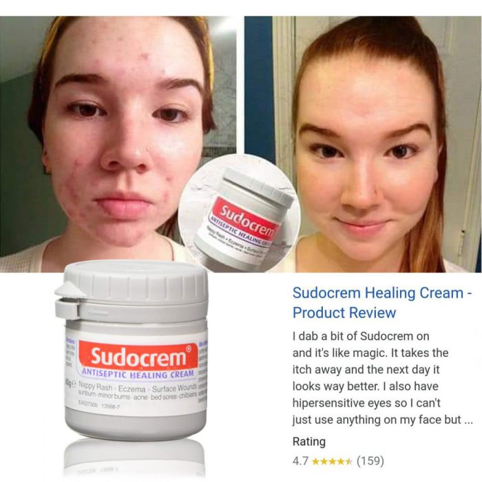 کرم ترمیم کننده و ضد سوختگی سودوکرم Sudocrem Antiseptic Healing Cream