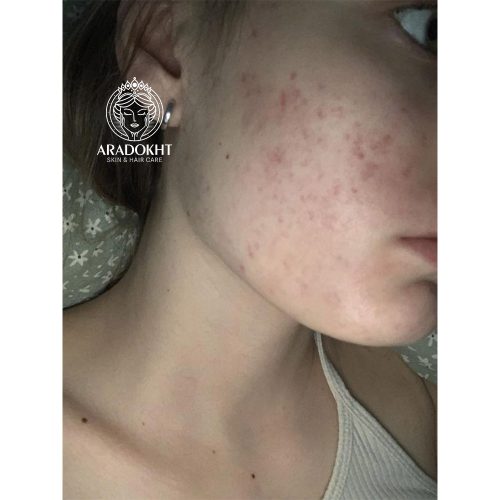 اسنس تقویت کننده و تسکین دهنده ریدل شات 100 وی تی کازمتیک VT COSMETICS CICA Reedle Shot 100 Essence