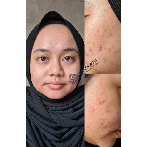فوم پاک کننده سالیسیلیک اسید مدی کیوب Medicube Red Foam Cleanser