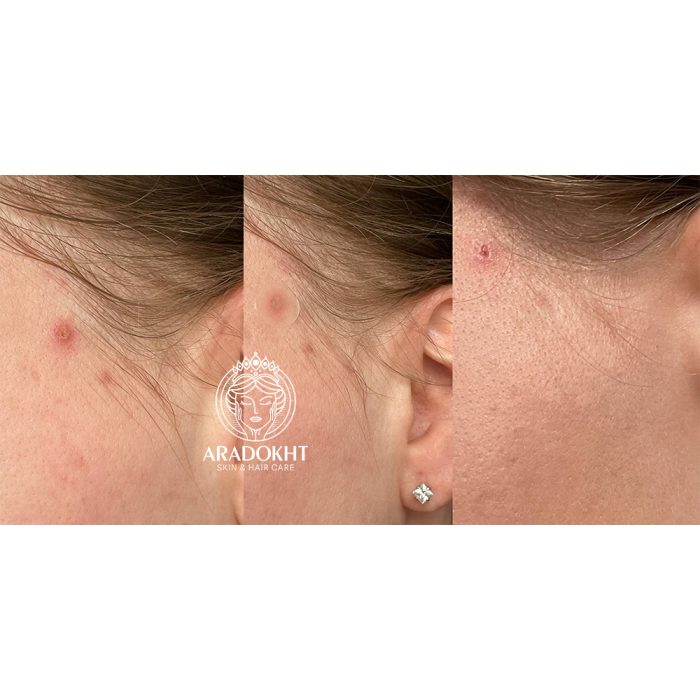 پچ ضد جوش کوزارکس Cosrx Acne Pimple Master Patch