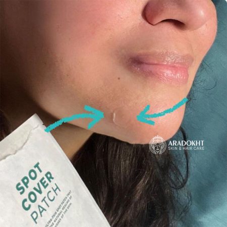 پچ ضد جوش تی تریکا اسکین 1004 SKIN1004 Madagascar Centella Tea-Trica Spot Cover Patch