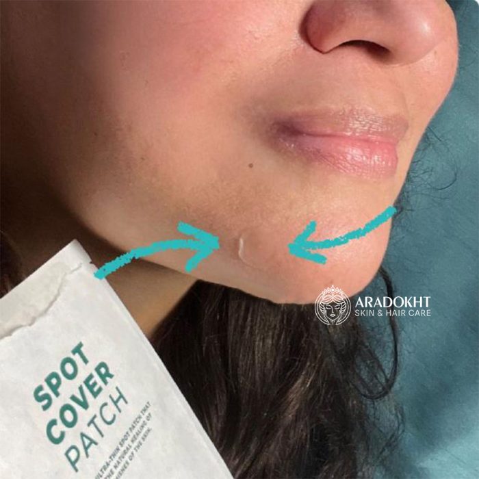 پچ ضد جوش تی تریکا اسکین 1004 SKIN1004 Madagascar Centella Tea-Trica Spot Cover Patch