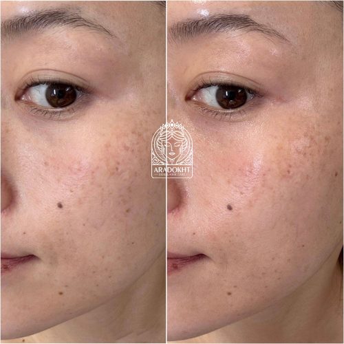 سرم آلفا آربوتین 2 درصد کوزارکس ضد لک و روشن کننده پوست COSRX The Alpha-Arbutin 2 Discoloration Care serum