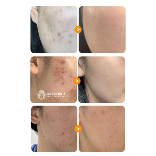 سرم ضد لک و قرمزی گودبای بلمیش شماره 5 نامبوزین Numbuzin No.5 Goodbye Blemish Serum