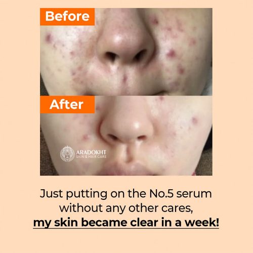 سرم ضد لک و قرمزی گودبای بلمیش شماره 5 نامبوزین Numbuzin No.5 Goodbye Blemish Serum