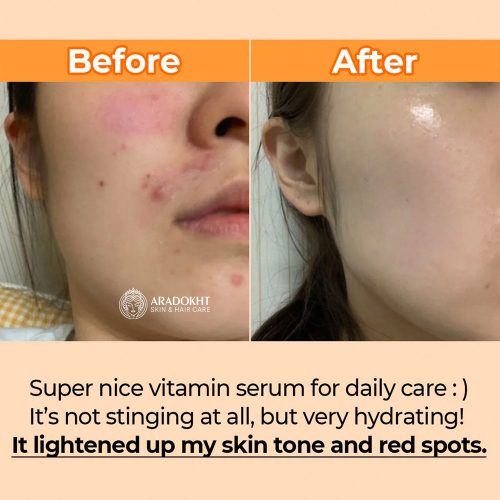 سرم ضد لک و قرمزی گودبای بلمیش شماره 5 نامبوزین Numbuzin No.5 Goodbye Blemish Serum