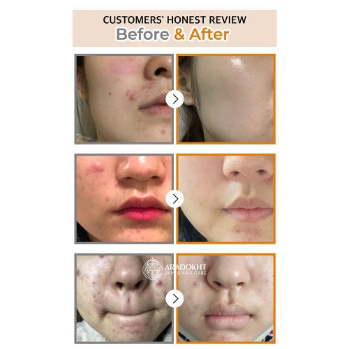 سرم ضد لک و قرمزی گودبای بلمیش شماره 5 نامبوزین Numbuzin No.5 Goodbye Blemish Serum