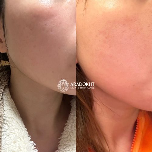 سرم ضدجوش و تسکین دهنده مدی کیوب Medicube Red Serum