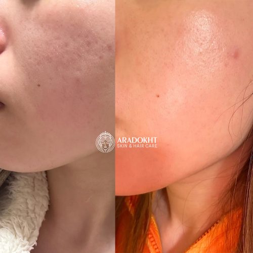 سرم ضدجوش و تسکین دهنده مدی کیوب Medicube Red Serum