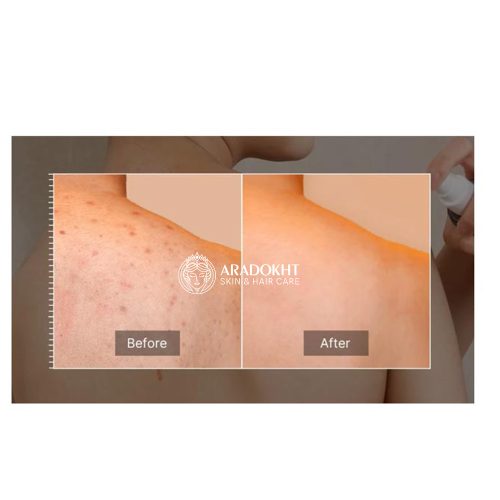 اسپری لایه بردار و ضد جوش بدن مدی کیوب Medicube Red Acne Body Peeling Shot