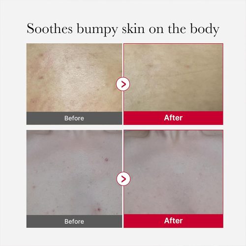 اسپری لایه بردار و ضد جوش بدن مدی کیوب Medicube Red Acne Body Peeling Shot