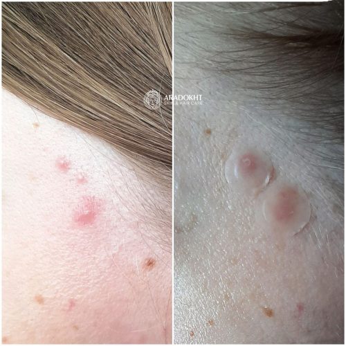 پچ ضد جوش و آکنه میراکل سام بای می SOMEBYMI 30 days Miracle Clear Spot Patches