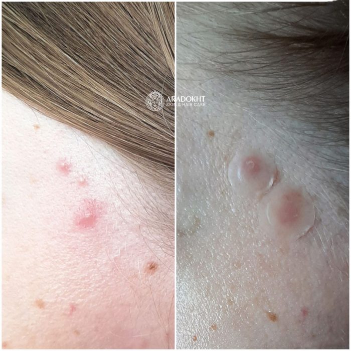 پچ ضد جوش و آکنه میراکل سام بای می SOMEBYMI 30 days Miracle Clear Spot Patches