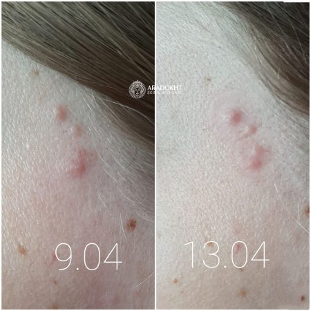 پچ ضد جوش و آکنه میراکل سام بای می SOMEBYMI 30 days Miracle Clear Spot Patches