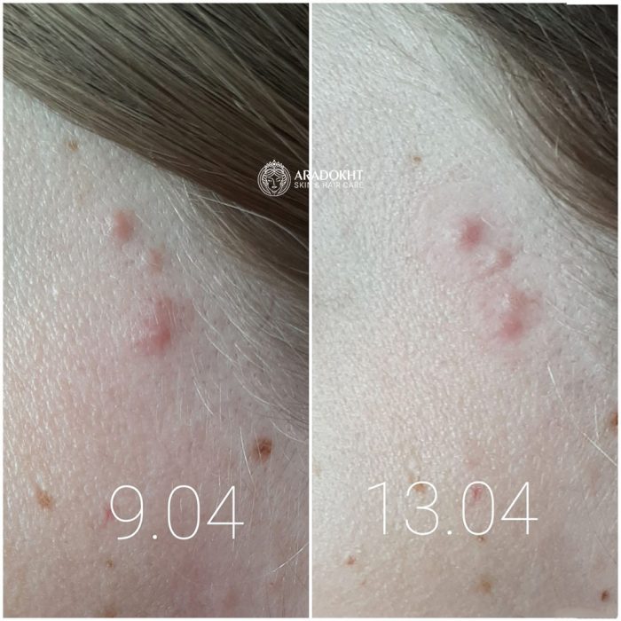 پچ ضد جوش و آکنه میراکل سام بای می SOMEBYMI 30 days Miracle Clear Spot Patches