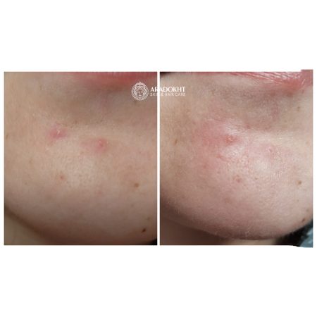 پچ ضد جوش و آکنه میراکل سام بای می SOMEBYMI 30 days Miracle Clear Spot Patches