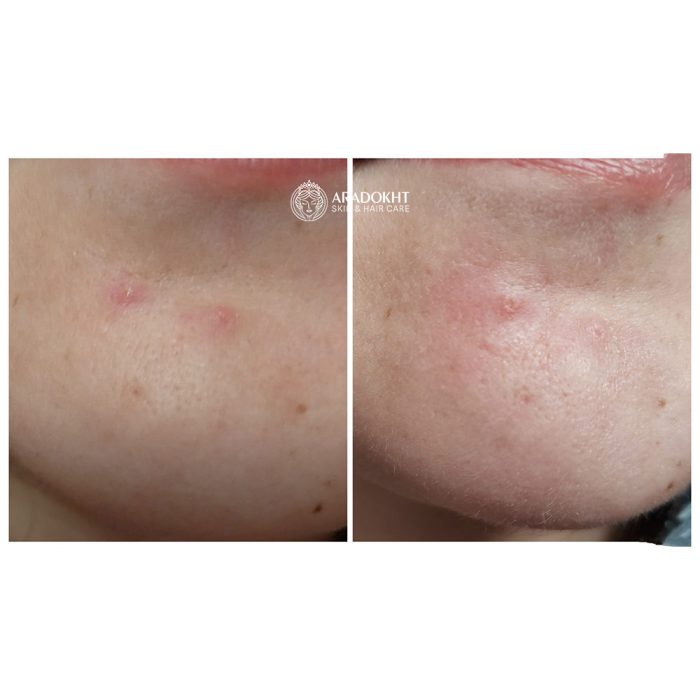 پچ ضد جوش و آکنه میراکل سام بای می SOMEBYMI 30 days Miracle Clear Spot Patches