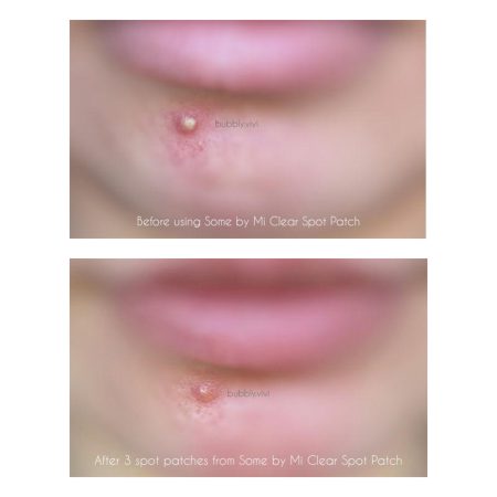 پچ ضد جوش و آکنه میراکل سام بای می SOMEBYMI 30 days Miracle Clear Spot Patches