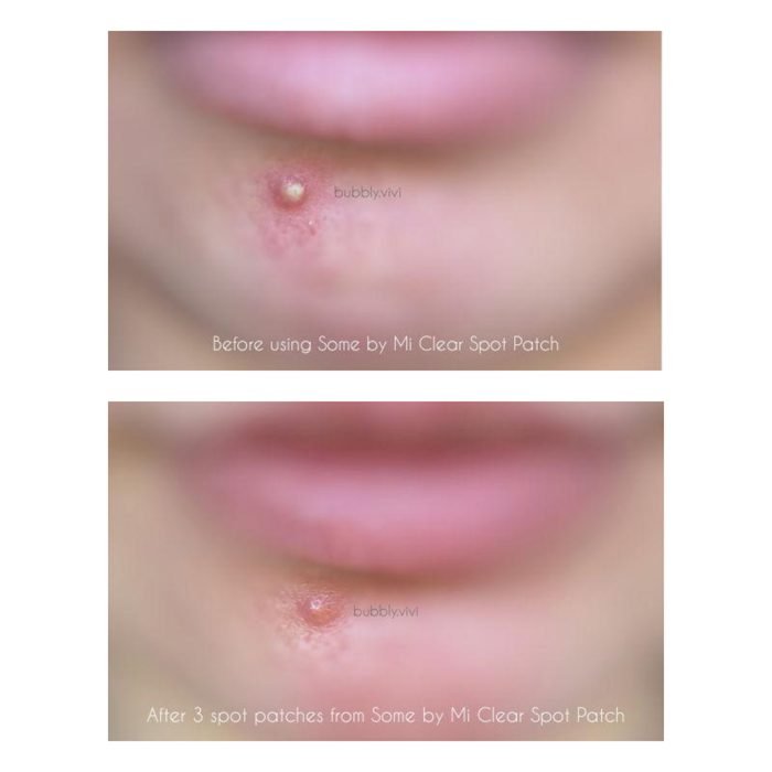 پچ ضد جوش و آکنه میراکل سام بای می SOMEBYMI 30 days Miracle Clear Spot Patches