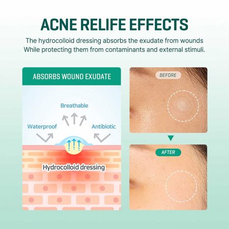 پچ ضد جوش و آکنه میراکل سام بای می SOMEBYMI 30 days Miracle Clear Spot Patches