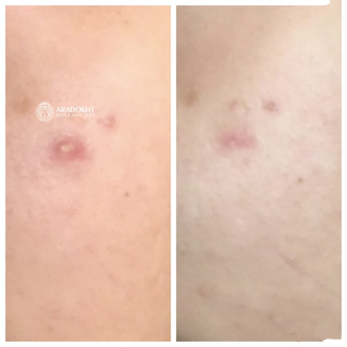 پچ ضد جوش و آکنه میراکل سام بای می SOMEBYMI 30 days Miracle Clear Spot Patches