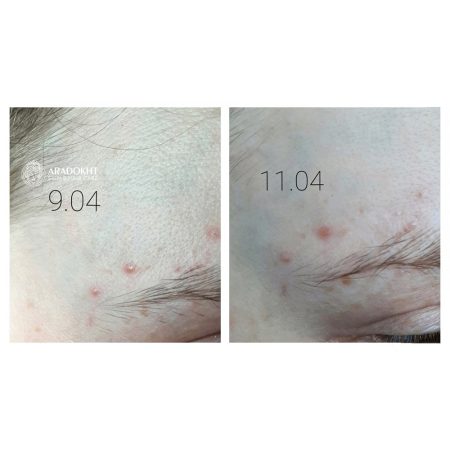 پچ ضد جوش و آکنه میراکل سام بای می SOMEBYMI 30 days Miracle Clear Spot Patches