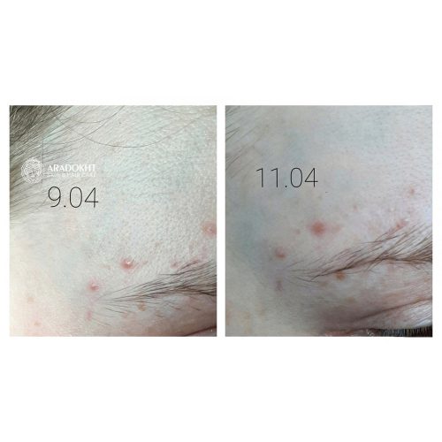 پچ ضد جوش و آکنه میراکل سام بای می SOMEBYMI 30 days Miracle Clear Spot Patches