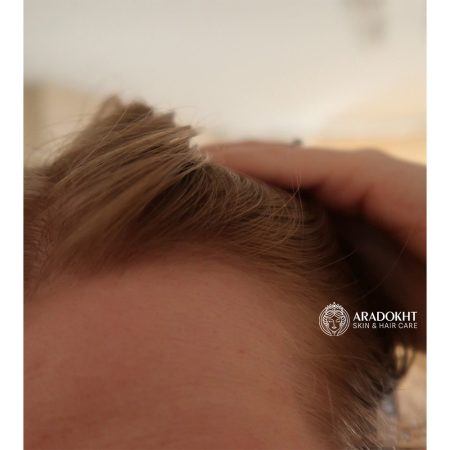 تونیک ضد ریزش مو سیکا و پپتاید سام بای می Some By Mi Cica Peptide Anti Hair Loss Derma Scalp Tonic