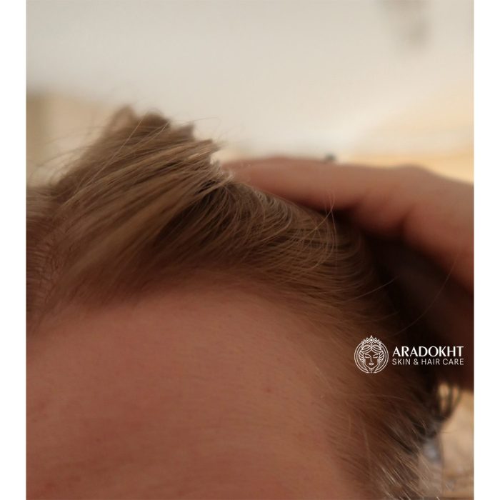 تونیک ضد ریزش مو سیکا و پپتاید سام بای می Some By Mi Cica Peptide Anti Hair Loss Derma Scalp Tonic