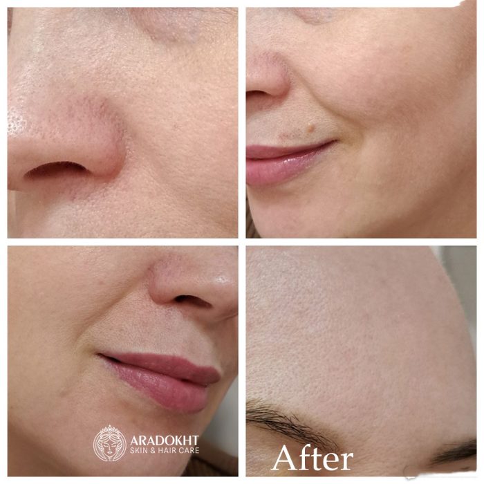 فوم ضد جوش و کنترل منافذ جوش شیرین سلیمکس Celimax Ji.Woo.Gae Baking Soda Deep Pore Foam Cleansing