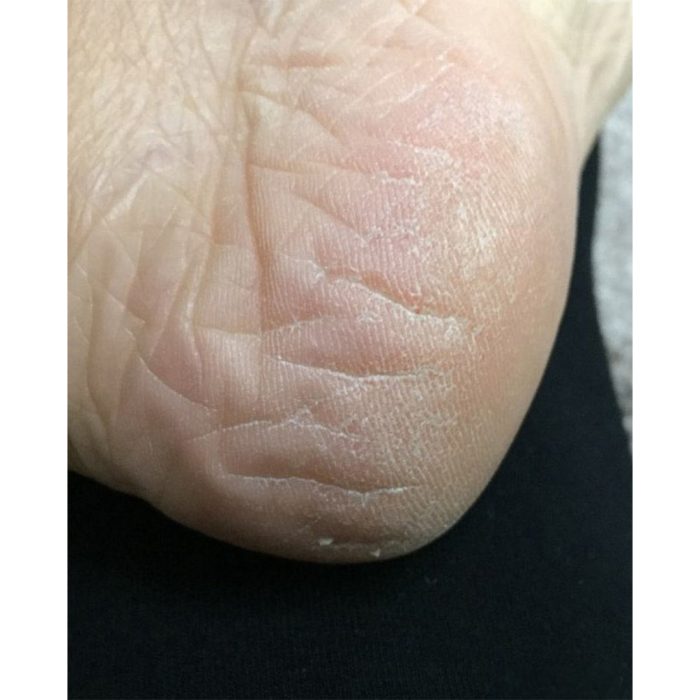 ماسک پا لایه بردار پیوردرم مدل پاپایا Purederm Exfoliating Foot Mask