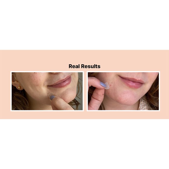 پچ 26 عددی ضد جوش و آکنه کوزارکس Cosrx AC Collection Acne Patch
