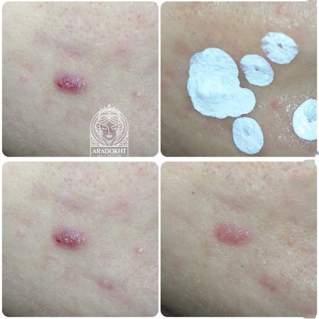 محلول ضد جوش و تسکین دهنده تی تری دکتر جارت Dr. Jart+ Ctrl-A Teatreement Soothing Spot