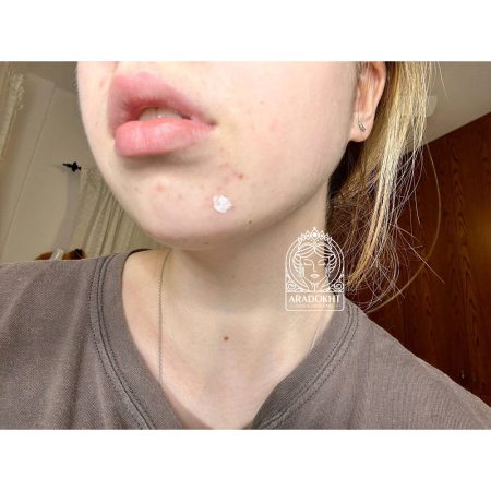 محلول ضد جوش و تسکین دهنده تی تری دکتر جارت Dr. Jart+ Ctrl-A Teatreement Soothing Spot