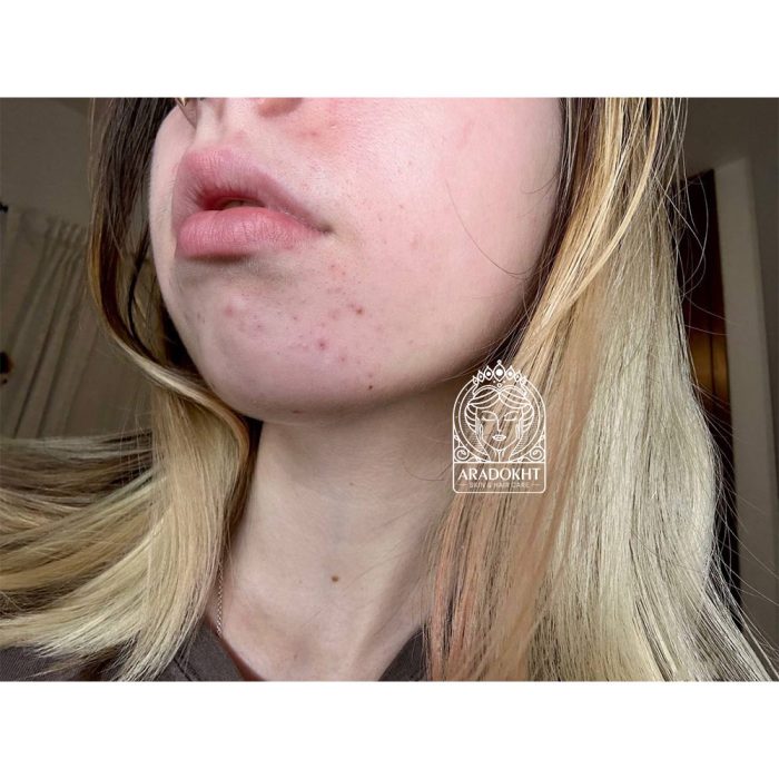 محلول ضد جوش و تسکین دهنده تی تری دکتر جارت Dr. Jart+ Ctrl-A Teatreement Soothing Spot