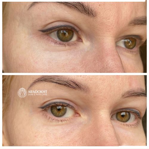 پک اختصاصی دور چشم ترانگزامیک اسید و گواشا مری اند می Mary & May Glutathione Eye Cream Kit
