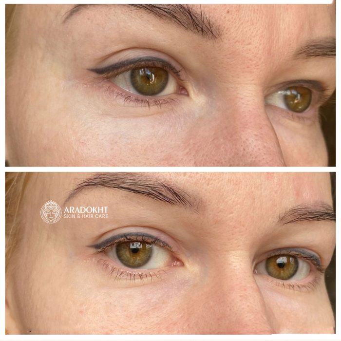 پک اختصاصی دور چشم ترانگزامیک اسید و گواشا مری اند می Mary & May Glutathione Eye Cream Kit