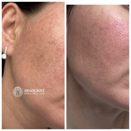 کرم ضد لک و روشن کننده ملانون ایکس مدی پیل MEDI-PEEL Melanon X Cream