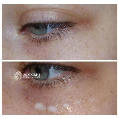 کرم دور چشم ترانگزامیک اسید و رتینال دکتر ملاکسین ضد چروک و روشن کننده قوی Dr.Melaxin TX Retinalsome Double Effect Eye Cream