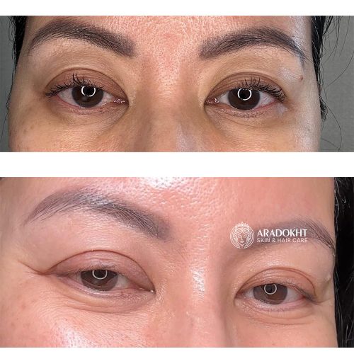 کرم دور چشم ترانگزامیک اسید و رتینال دکتر ملاکسین ضد چروک و روشن کننده قوی Dr.Melaxin TX Retinalsome Double Effect Eye Cream