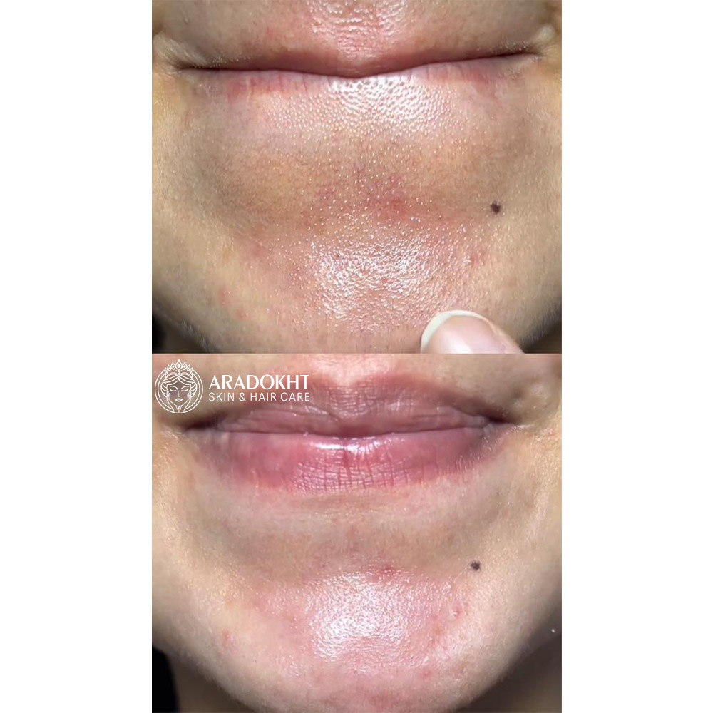 شوینده روغنی کنترل منافذ موچی آرنسیا Arencia Pore Melt Mochi Cleansing Oil