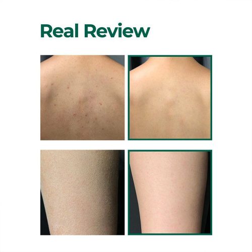 لوسیون بدن میراکل سام بای می ضدجوش، لایه بردار ملایم و تسکین دهنده پوست SOME BY MI AHA, BHA, PHA Miracle Calming Body Lotion