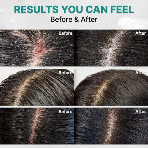 شامپو ضد شوره، خنک کننده، پاک کننده عمقی و کنترل چربی سیکا PDRN لیلیوئه lilyeve Scalp Turn Cica PDRN Deep Clean Shampoo