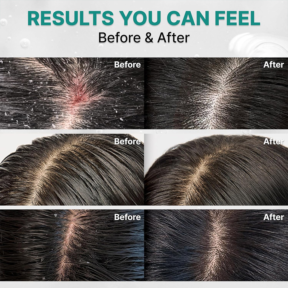 شامپو ضد شوره، خنک کننده، پاک کننده عمقی و کنترل چربی سیکا PDRN لیلیوئه lilyeve Scalp Turn Cica PDRN Deep Clean Shampoo