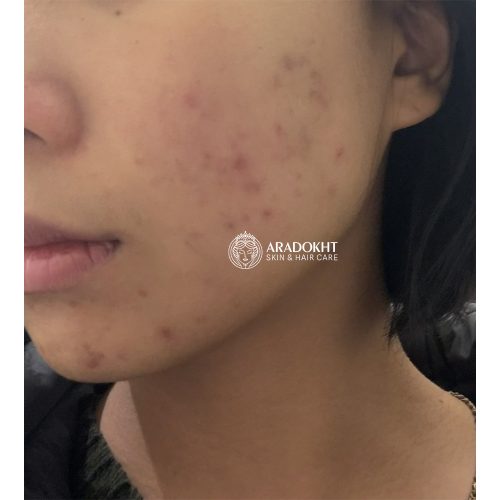 ژل میسلار بدون چربی زیرو بلمیش نامبوزین ضد جوش و پاک کننده عمقی پوست numbuzin Zero Blemish Oil-Free Micellar Cleansing Jelly