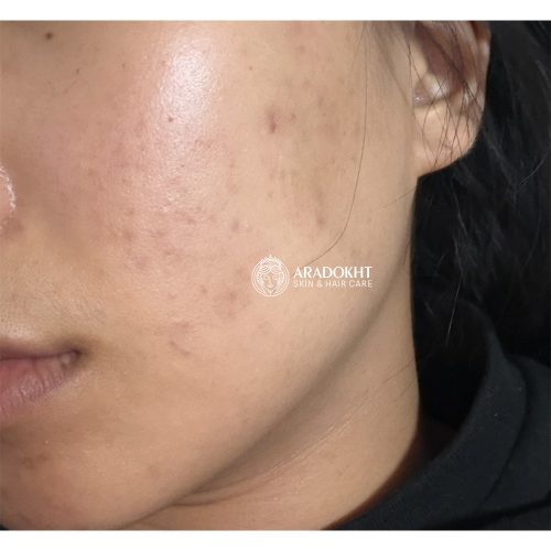 ژل میسلار بدون چربی زیرو بلمیش نامبوزین ضد جوش و پاک کننده عمقی پوست numbuzin Zero Blemish Oil-Free Micellar Cleansing Jelly