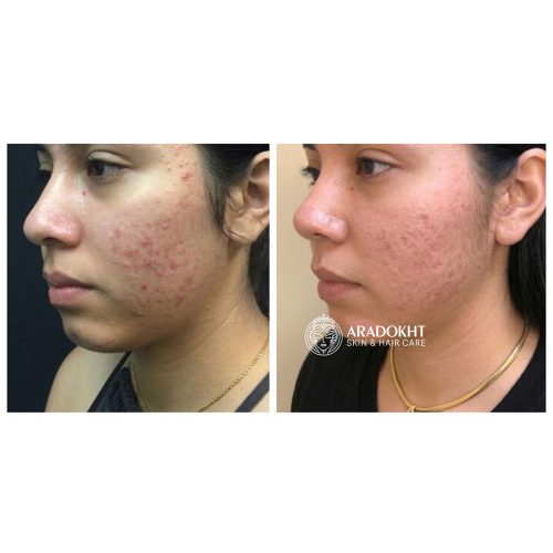 ژل میسلار بدون چربی زیرو بلمیش نامبوزین ضد جوش و پاک کننده عمقی پوست numbuzin Zero Blemish Oil-Free Micellar Cleansing Jelly